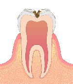 ［画像］C2 象牙質まで達した虫歯