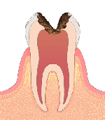 ［画像］C3 神経まで達した虫歯