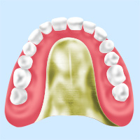 ［画像］金属床義歯