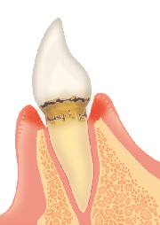 歯周病で歯を失う前に……