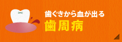 歯ぐきから血が出る【歯周病】