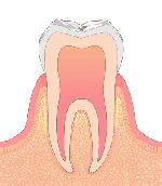 ［画像］CO 初期のむし歯