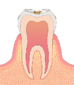 ［画像］C1 エナメル質まで達した虫歯