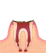 ［画像］C4 歯根まで達したむし歯